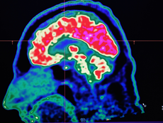 Beaming lights into the brain can recreate the feeling of ketamine, and scientists have already done it