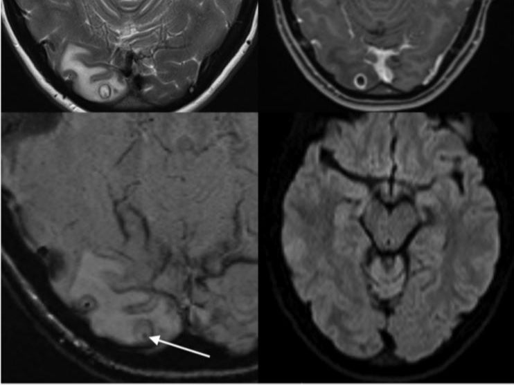 MRI scan showing cyst containing tapeworm larvae