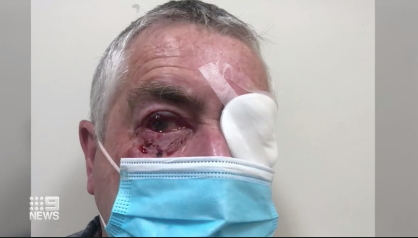 Australian man undergoes eye surgery after attack by magpie