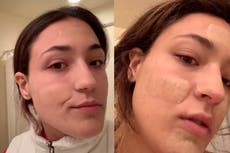 TikTok trend sees people using hydrocolloid bandages to treat acne