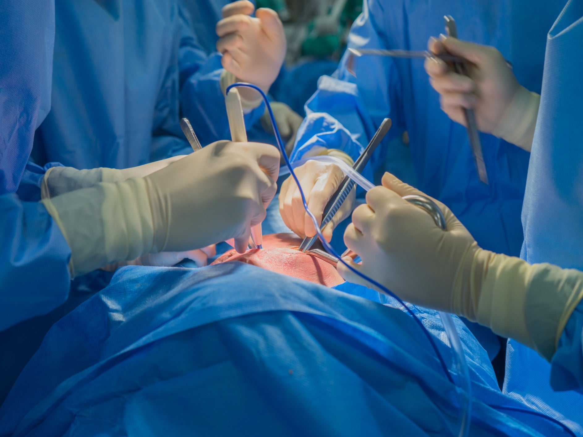 Organ transplant surgery across the NHS