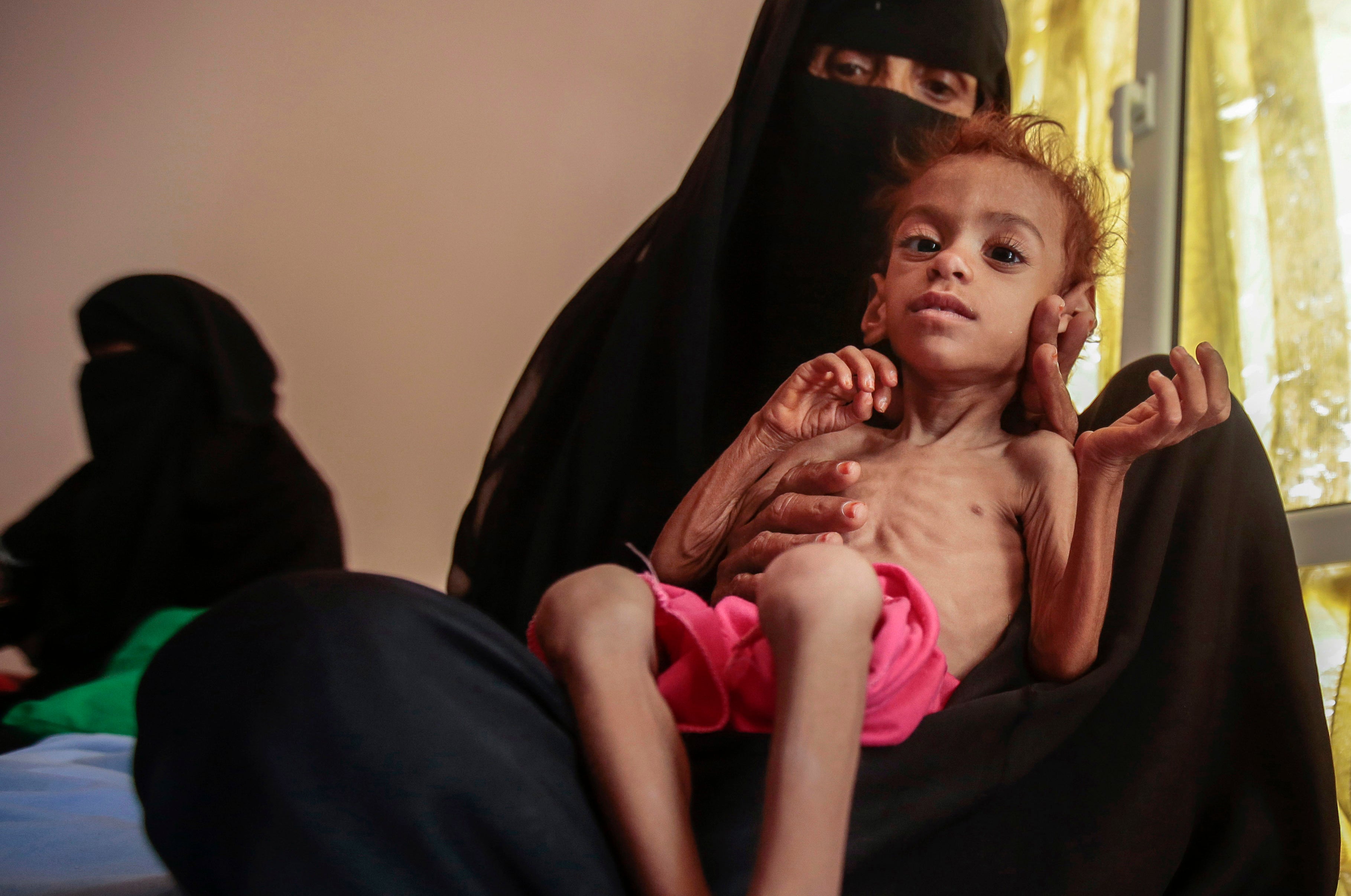 A woman holds a malnourished boy at the Aslam Health Center, in Hajjah, Yemen