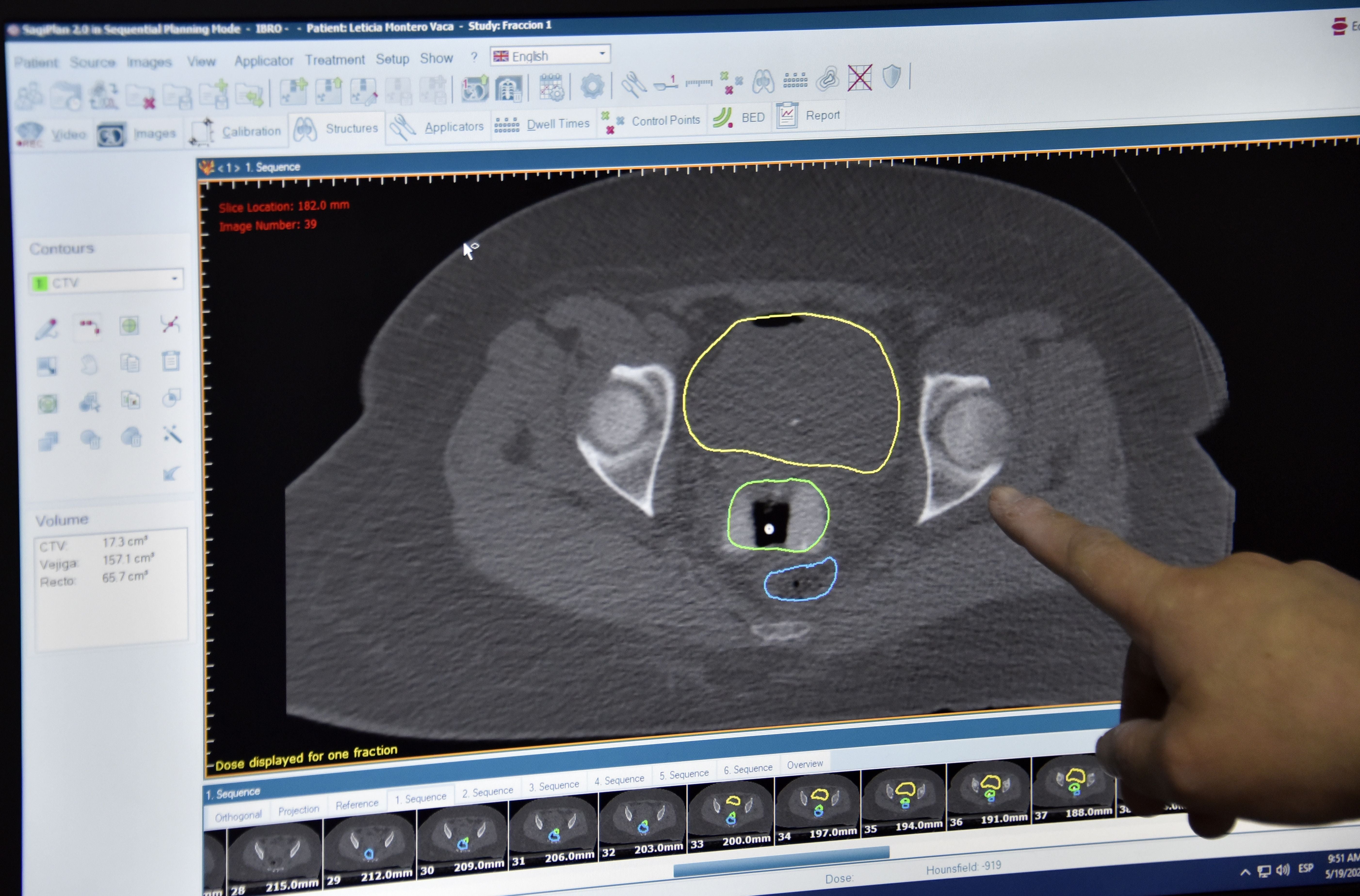 A doctor points at a screen with the tests of a patient suffering from cervical cancer during her first session of 3D high rate brachytherapy at the Bolivian Radiotherapy and Oncology Institute (IBRO) in El Alto, Bolivia