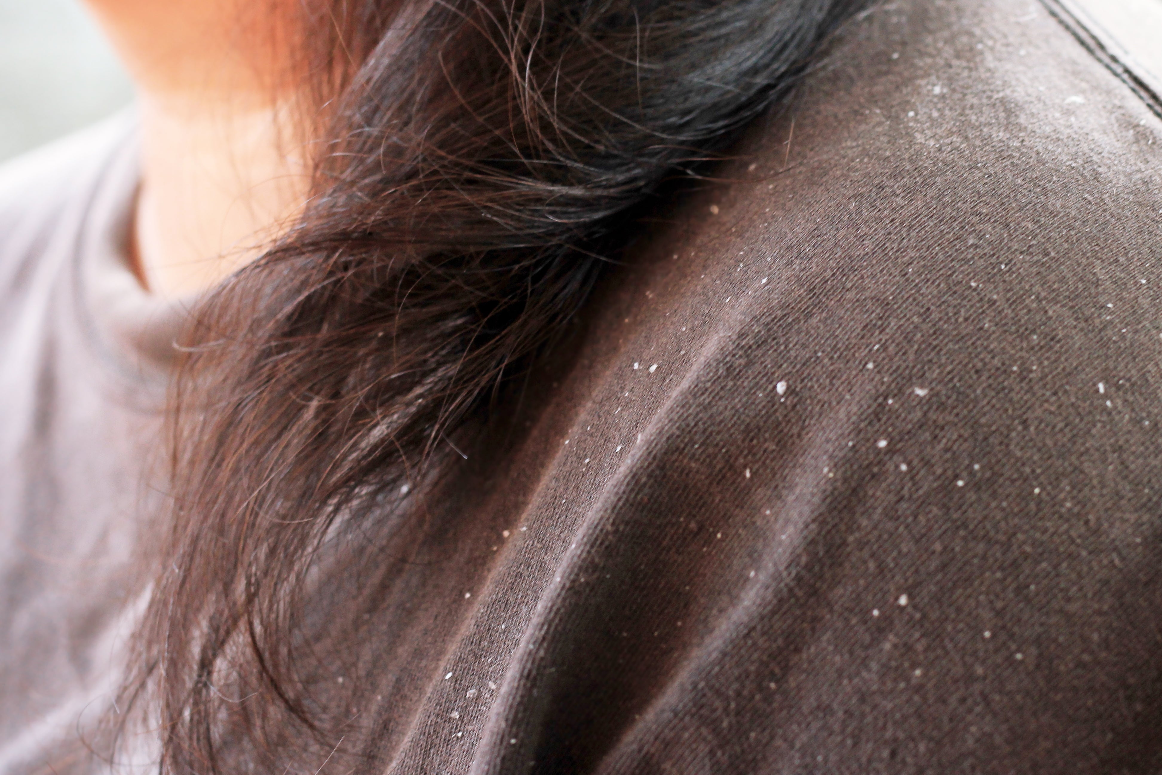 Dandruff can be both fine little scales, or sometimes larger scales