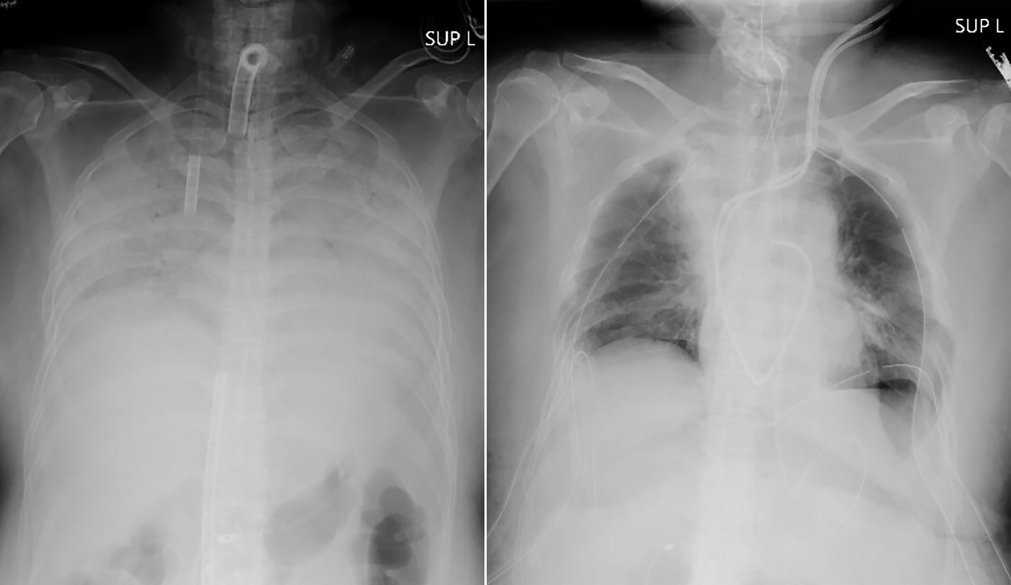 This combination of radiographs provided by Kyoto University Hospital shows the chest of a patient before the surgery, left, and after the surgery, right. Doctors in Kyoto University Hospital announced on 8 April 2021 that they have successfully performed the world’s first transplant of lung tissue from living donors to a patient with severe lung damage from Covid-19