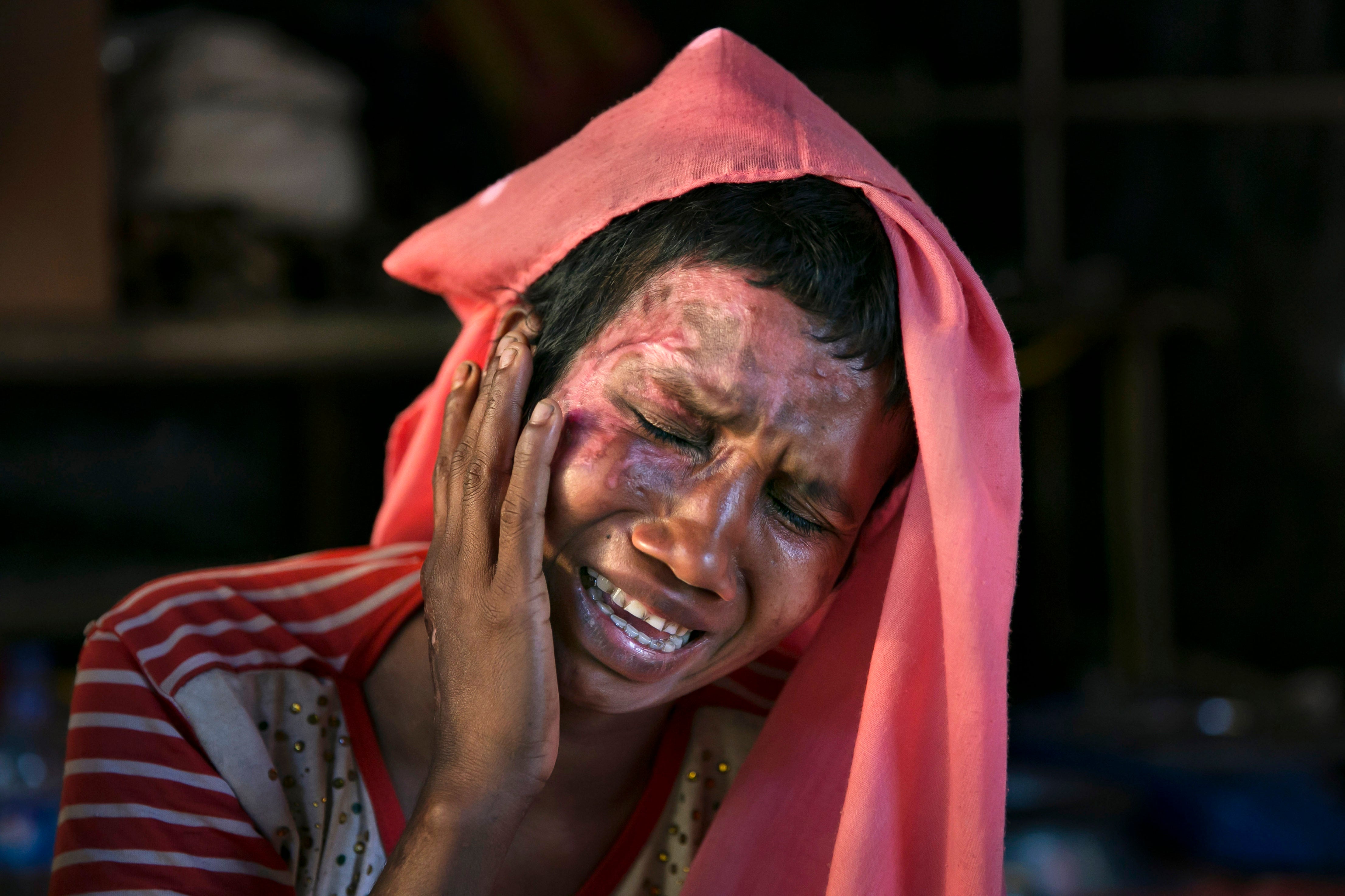 A woman becomes emotional as she touches the wounds she received when the military set her house on fire after raping her in Cox’s Bazar, Bangladesh, in 2017