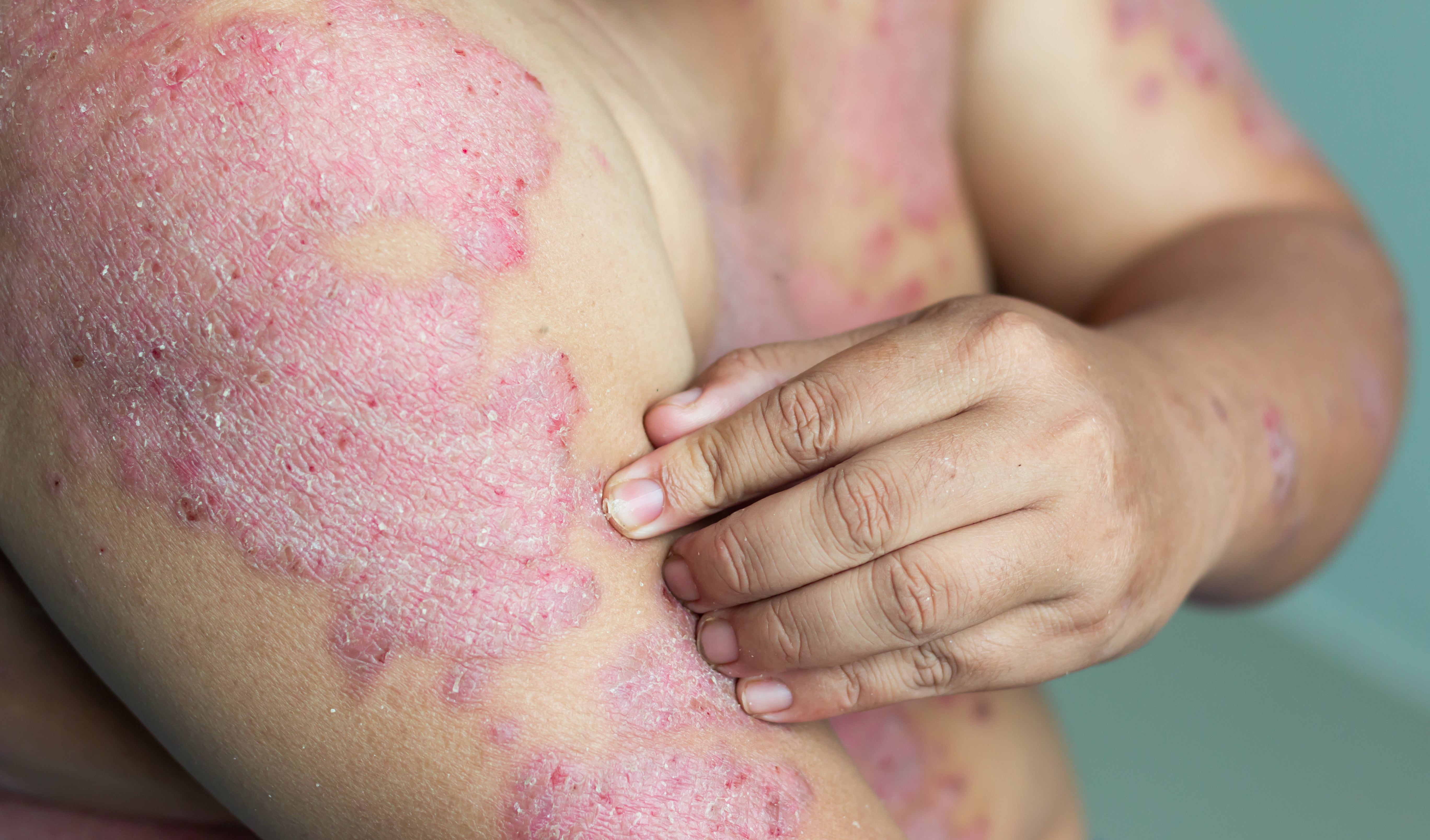 People with psoriasis feel constantly judged by others who incorrectly believe they are contagious