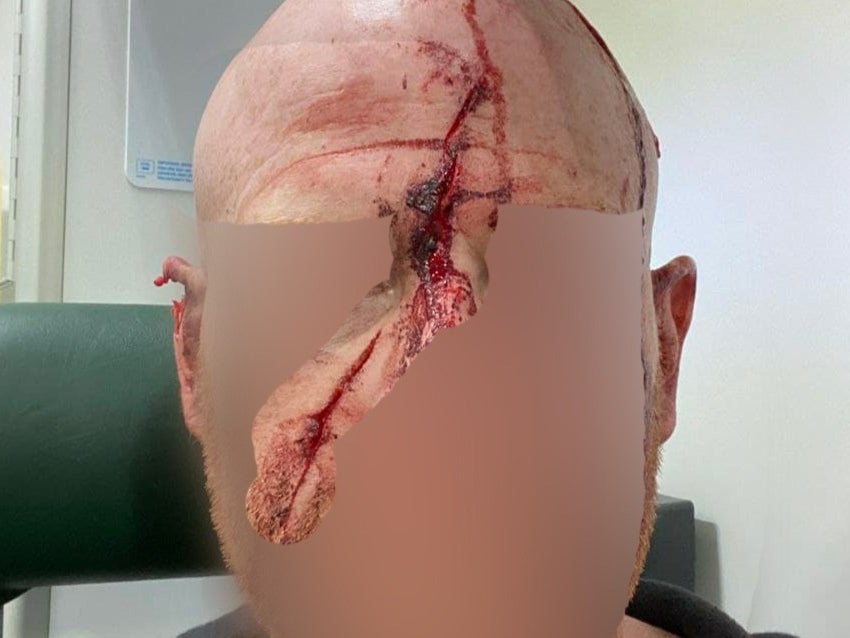 The volunteer’s head streaked with blood