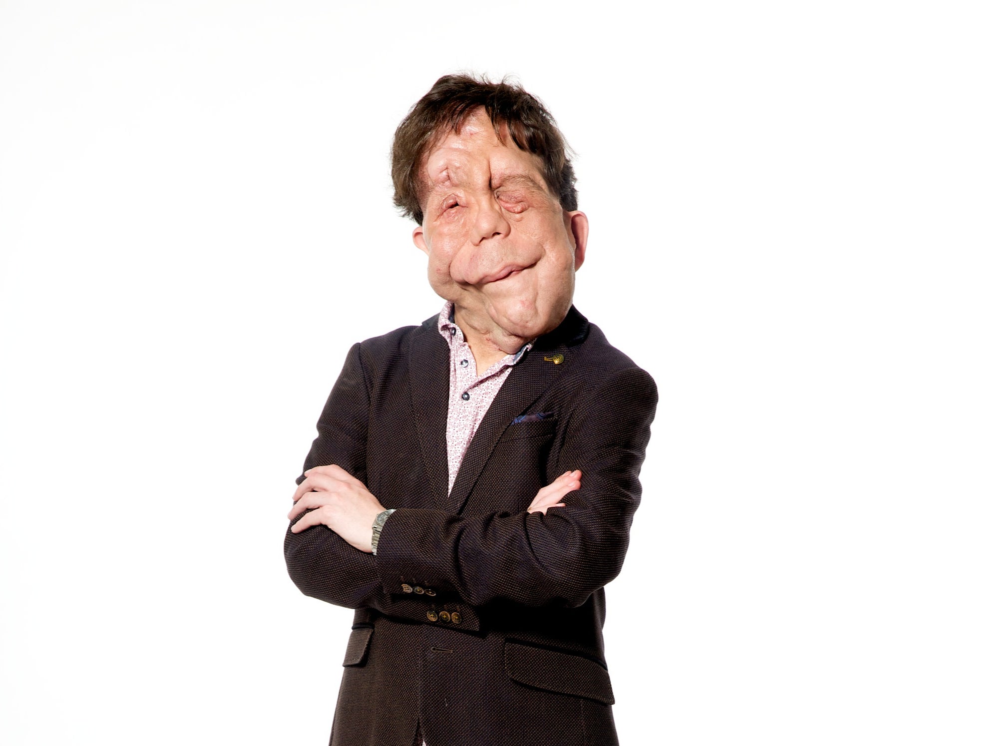 Adam Pearson, ambassador of Changing Faces