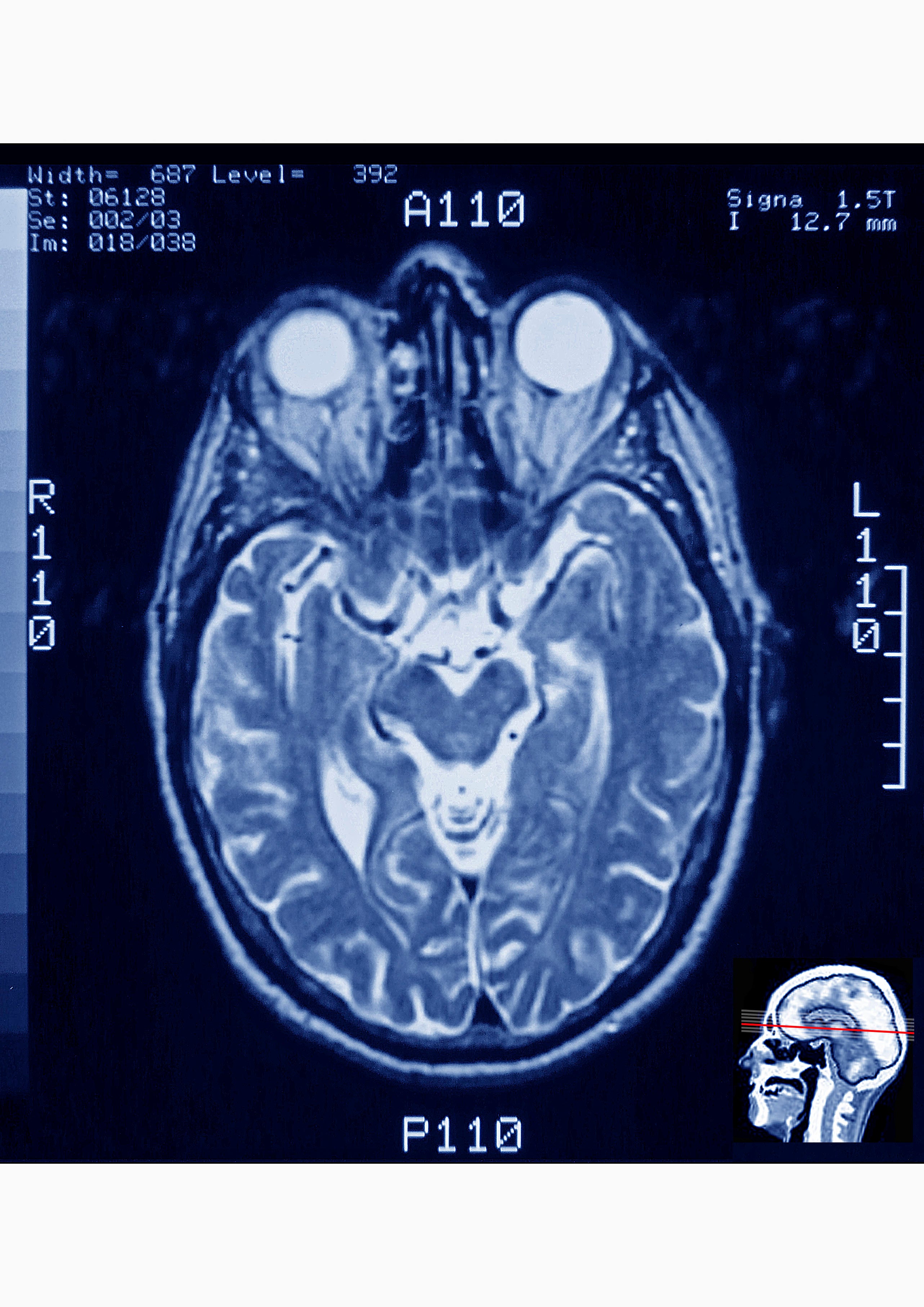 Axial section of a human skull showing the brain, eyes, optic nerves, sinuses and nasal fossae