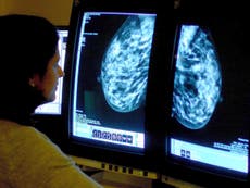 10,000 fewer patients began breast cancer treatment over past year, study shows