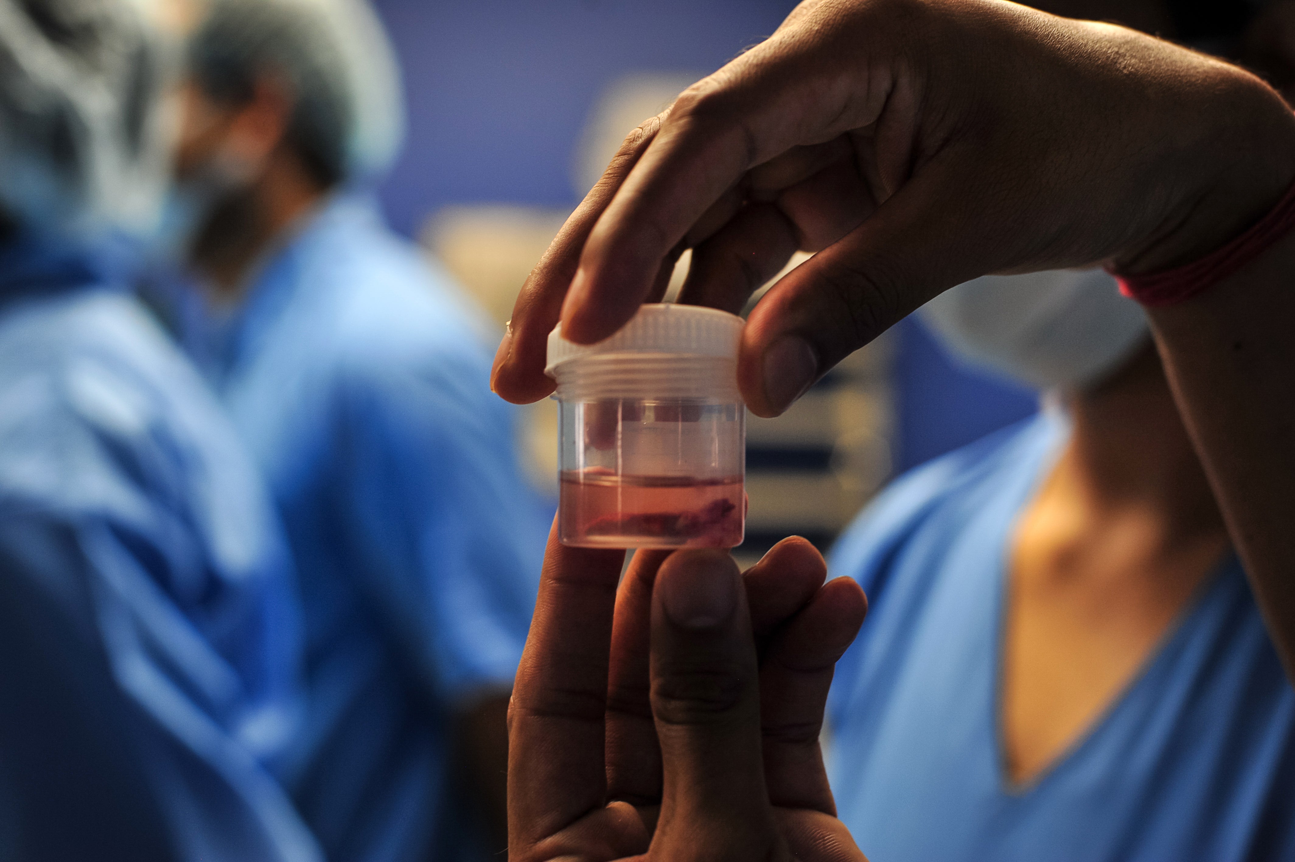 A doctor displays a piece of infected tissue after surgery to remove mucormycosis from a patient in Allahabad, India