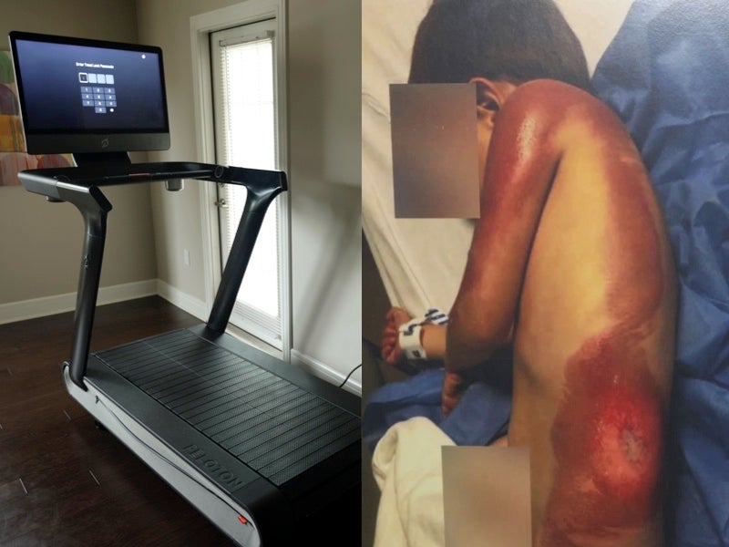 Parents sue Peloton after three-year-old sustains third-degree burns from treadmill