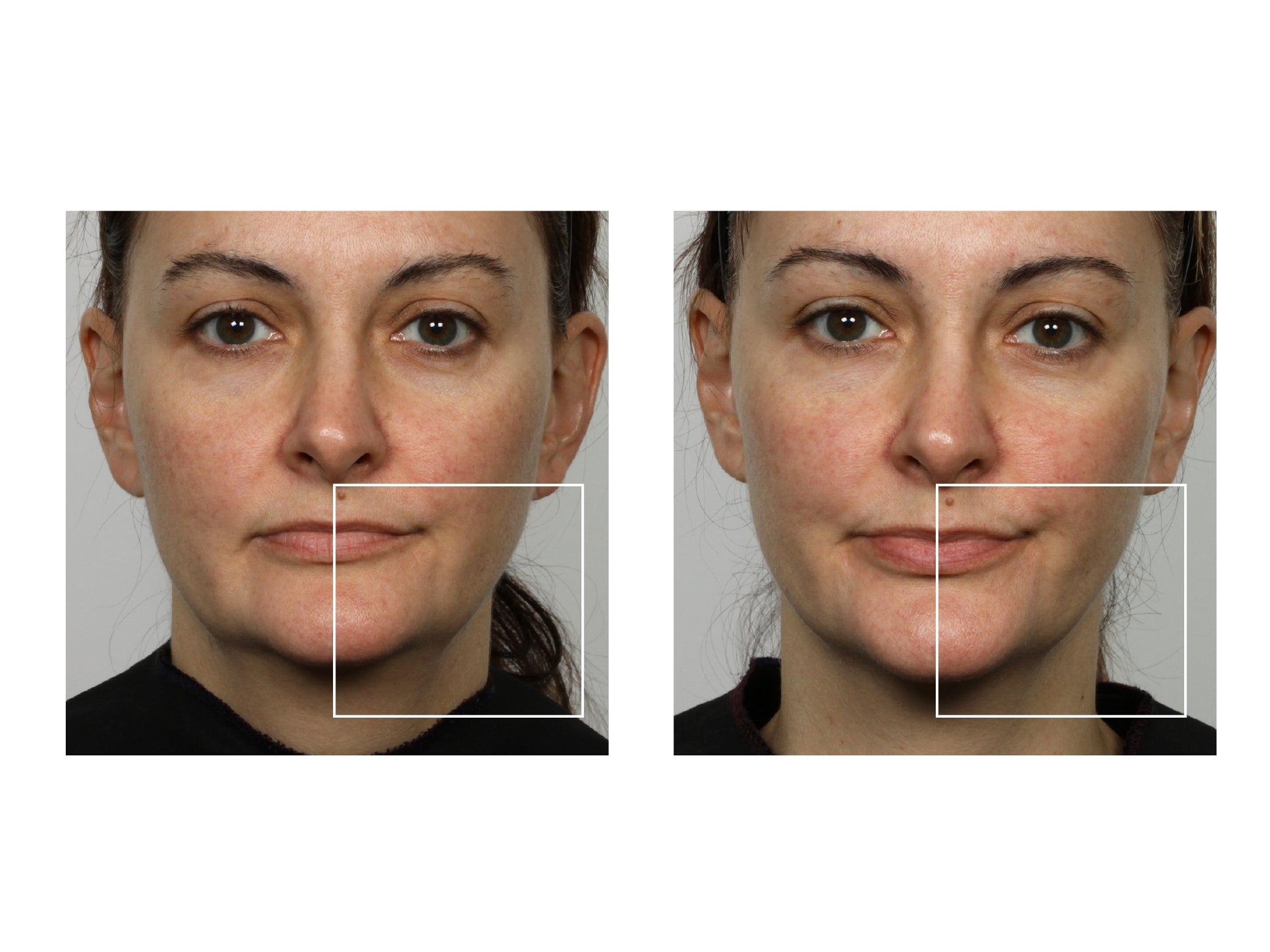 Before and after results using the NuFACE Mini device