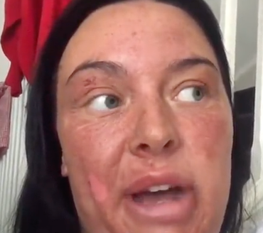 Chantelle Conway suffers ghastly burns after attempt to poach eggs using viral TikTok hack backfires