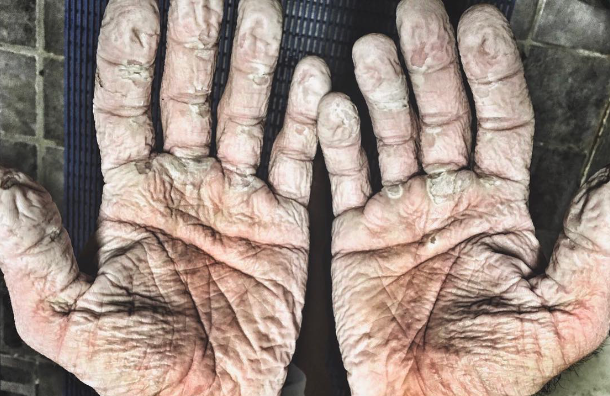 Olympic rower Alex Gregory of Great Britain shares with his followers his hands after he left them in wet gloves for too long