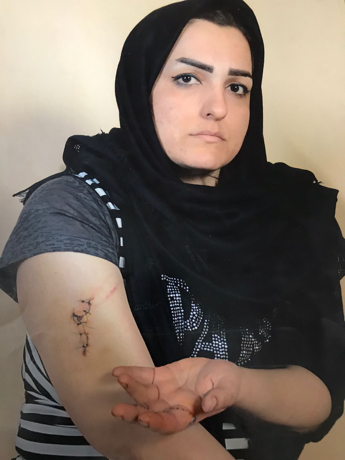 Fariba Akemi showing her injuries on her arm and fingers after the attack by her husband