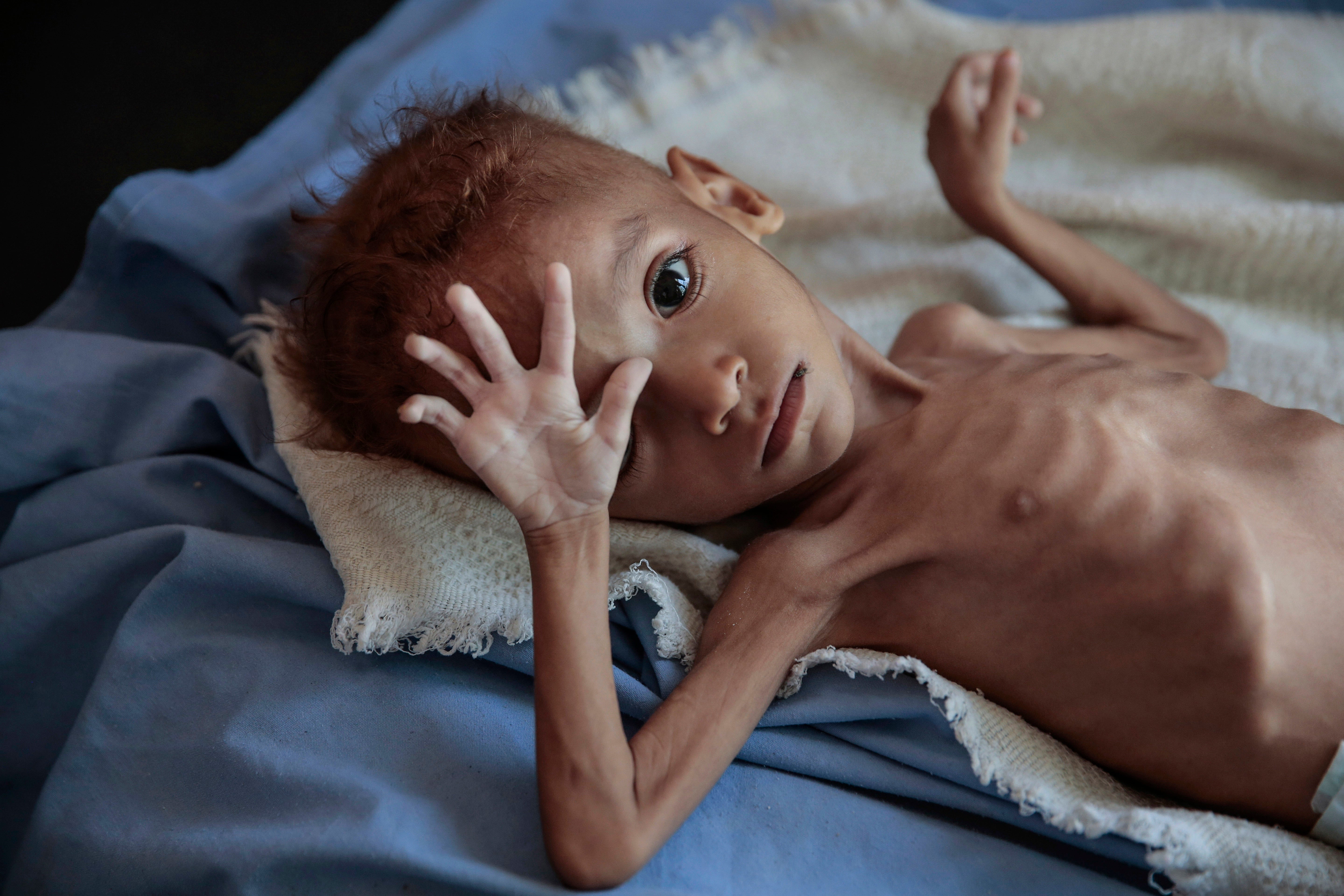 Yemen Starvation