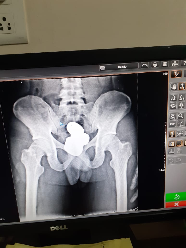 An X-ray of Mohammed Shereef’s abdomen, which allegedly shows he was concealing some metallic items in his body
