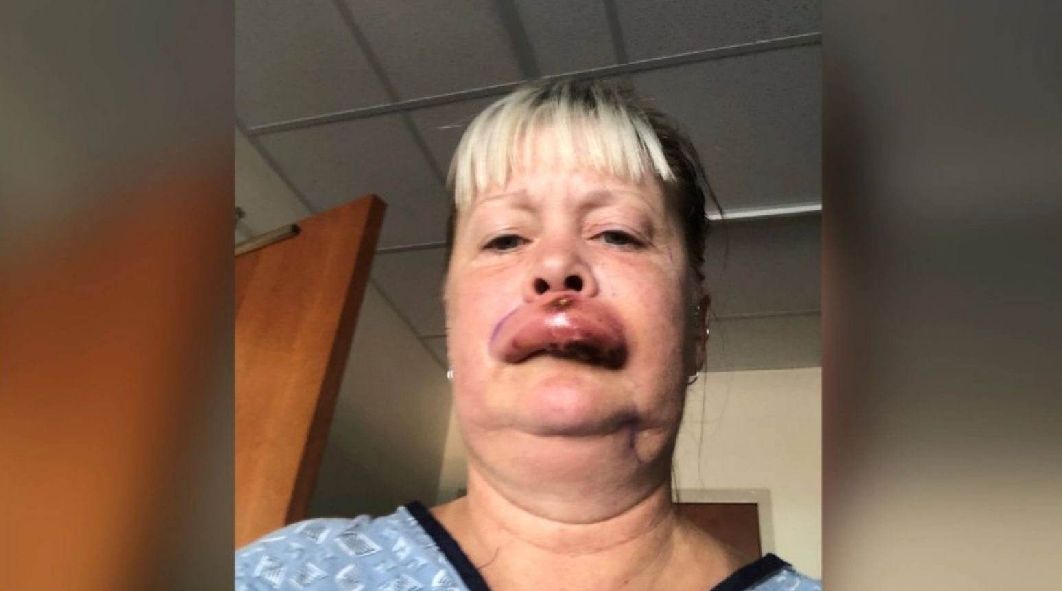 Sherri Maddox was bitten by a brown recluse spider.