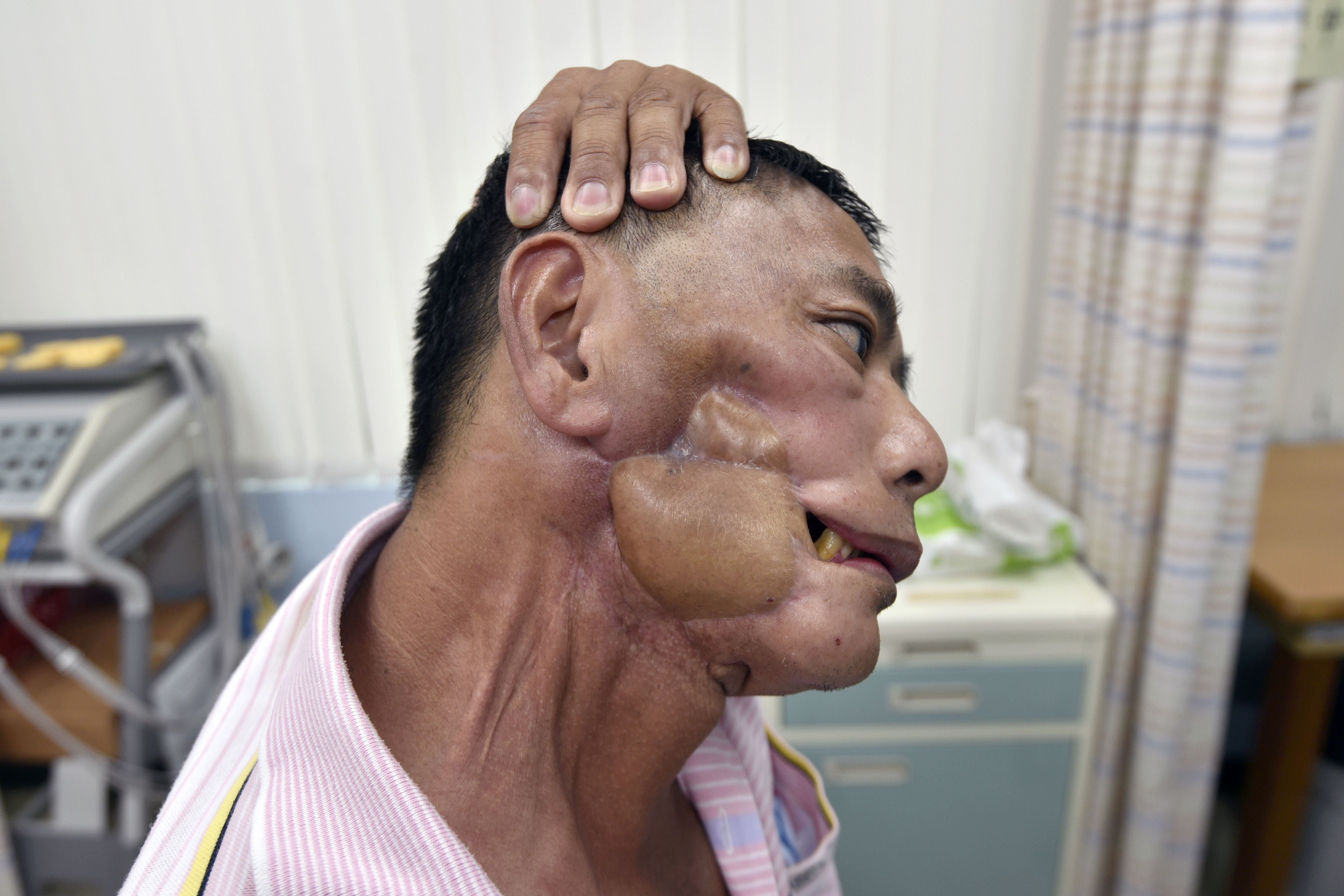 File A picture from 2017 shows Chen Yung-an, who had oral cancer, doing rehabilitation exercises at a recovery centre in Taipei