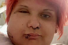 Dog walker’s face swells after she accidentally brushed against a toxic plant