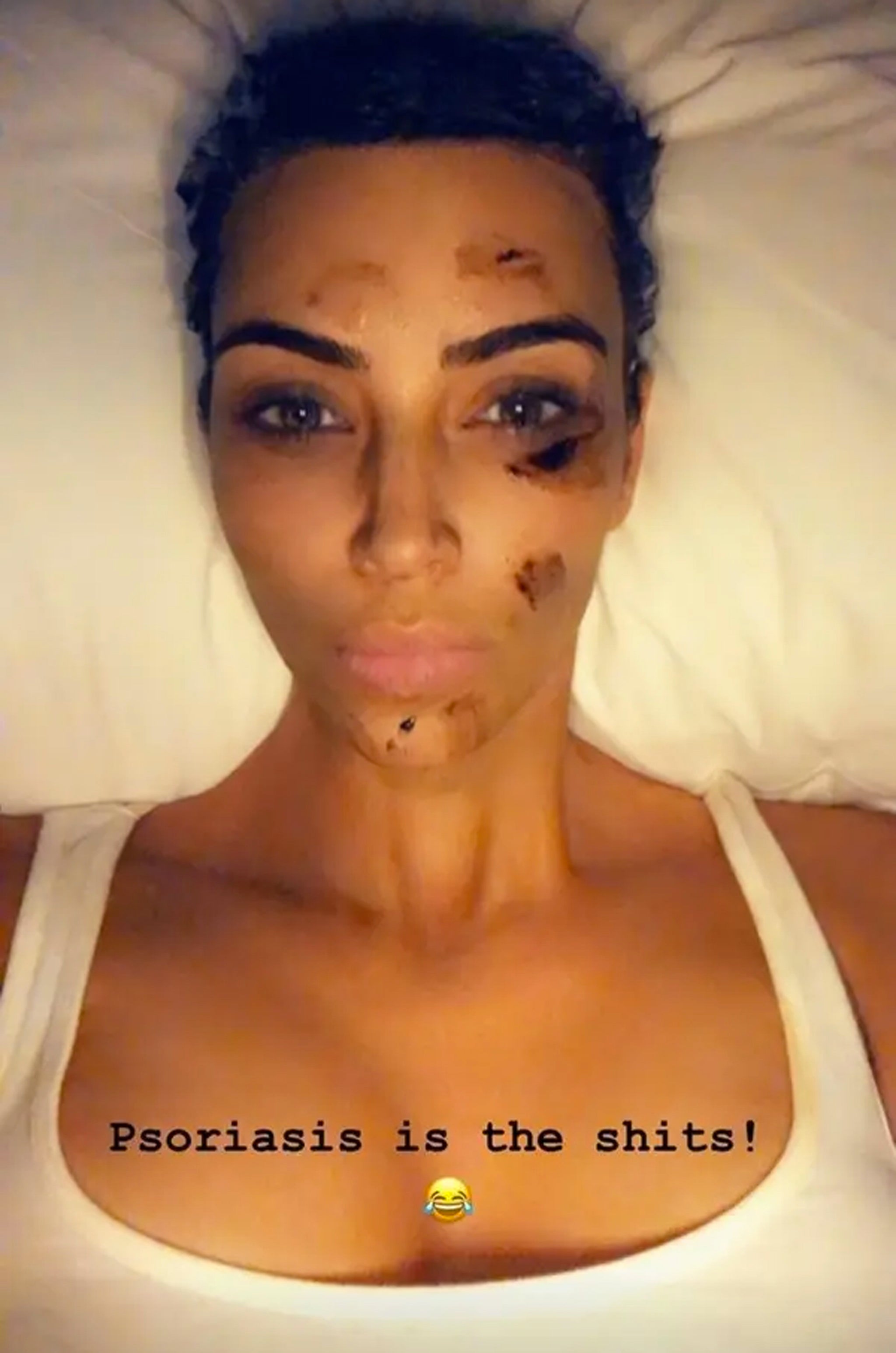 Kim Kardashian is very open about her psoriasis