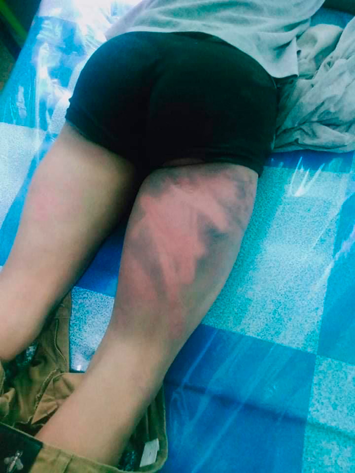 This undated photo shows injuries on a man who said he was tortured in June 2021 while being held at an interrogation centre in Myanmar's Chin state