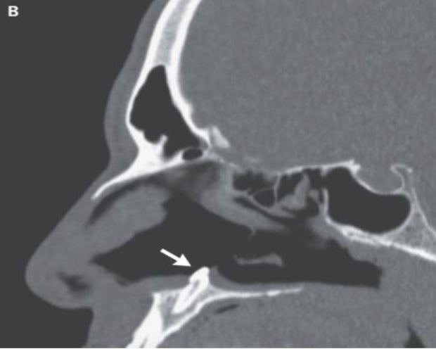 The ectopic tooth seen here growing inside the nose of a man causing breathing difficulties for him