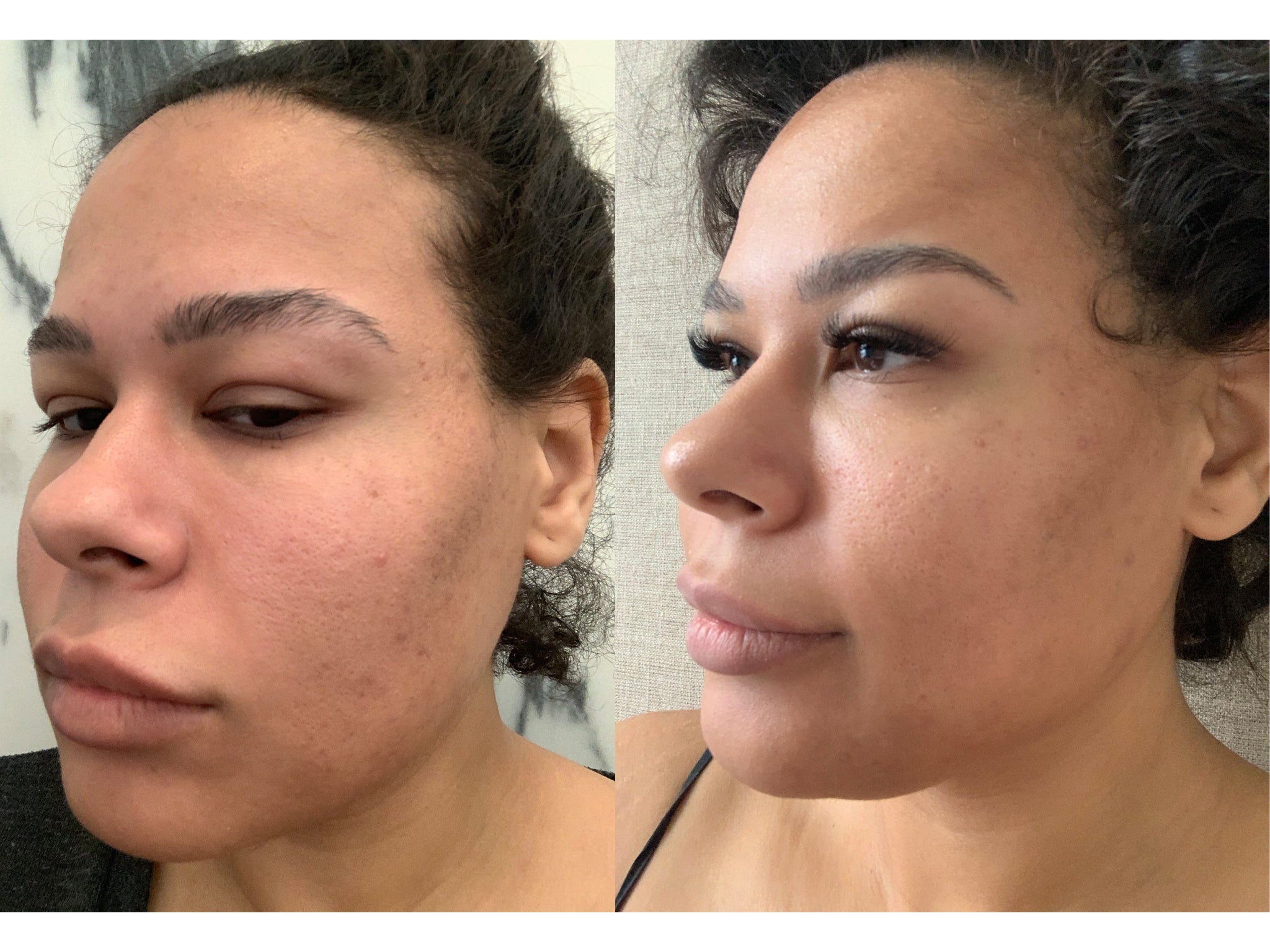 Before (left) and after (right) – our tested noticed a major reduction in breakouts and redness