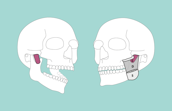 A newly discovered muscle layer (denoted in the photo by ‘C’) runs from the back of the cheekbone to the anterior muscular process of the lower jaw