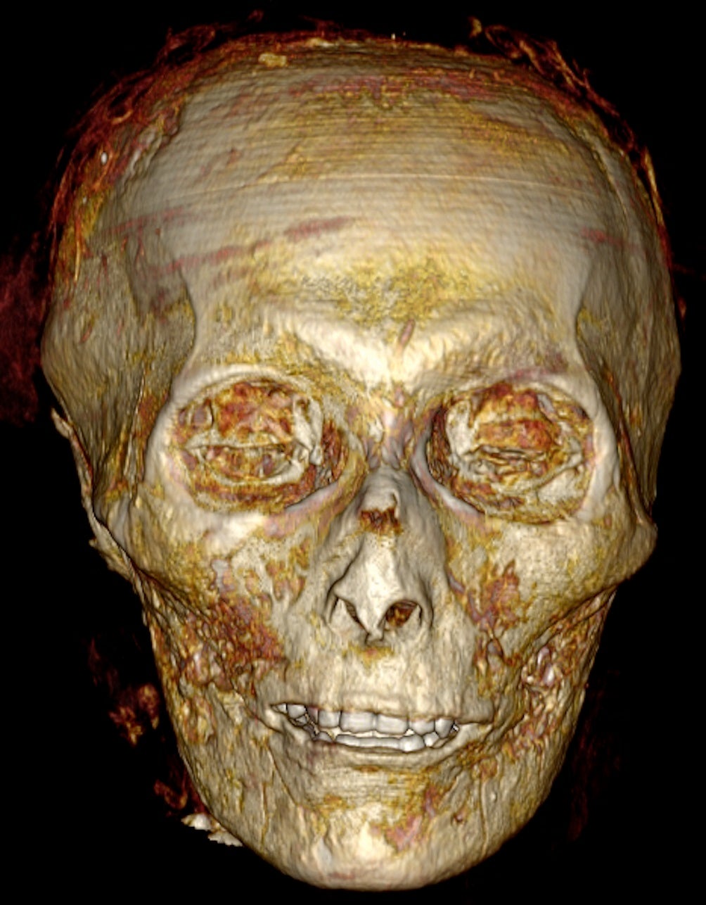 CT scan showing Amenhotep’s “well preserved” gold teeth