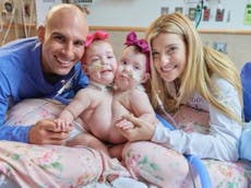 Doctors successfully separate conjoined Chicago twins in ‘superhero’ procedure