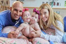 Doctors successfully separate conjoined Chicago twins in ‘superhero’ procedure