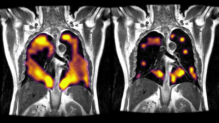 Researchers used xenon gas to detect potential lung damage in patients experiencing periods of breathlessness after having had the virus.