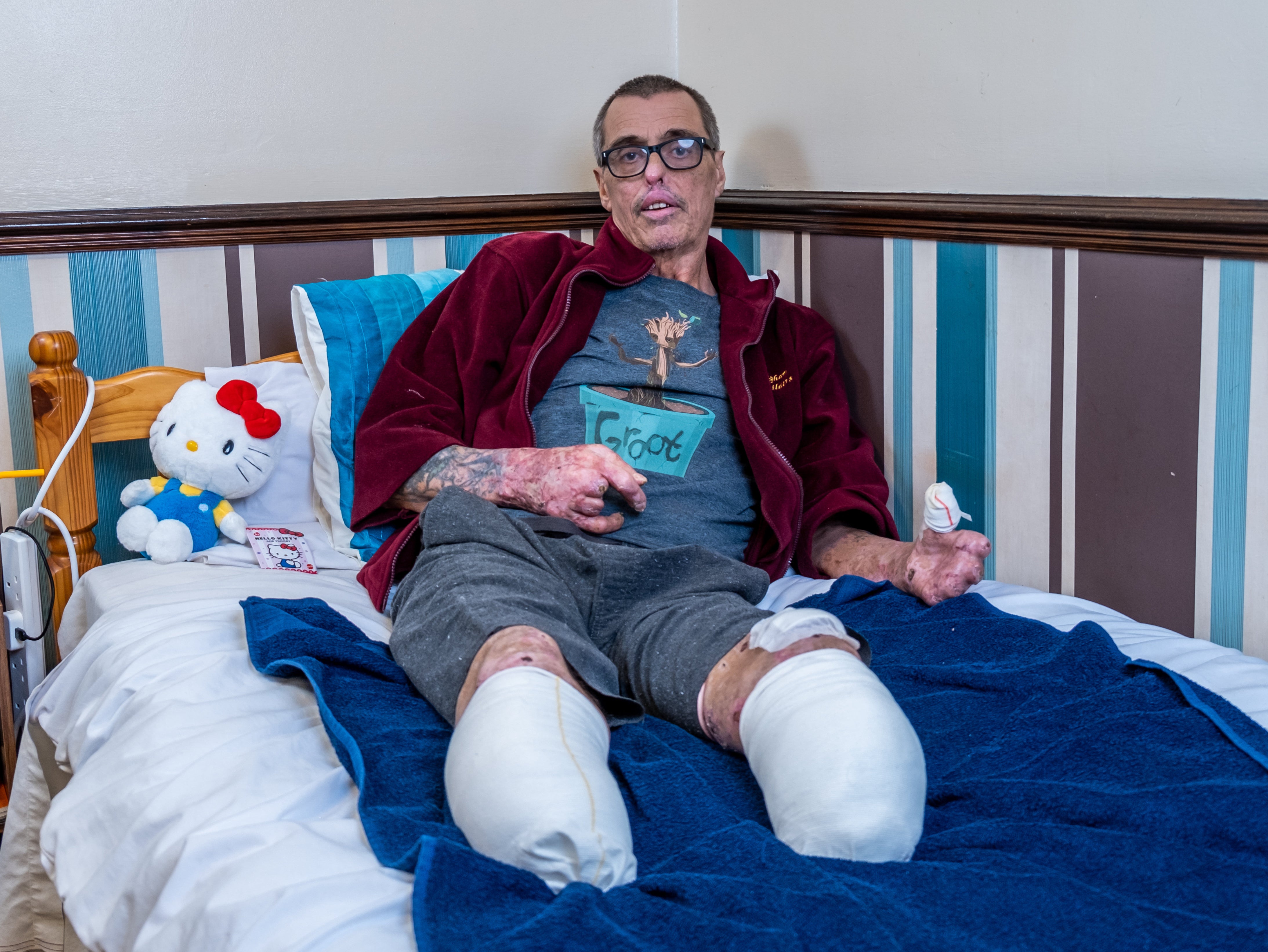 Mark Day, 61 at his home in Colchester after his operation