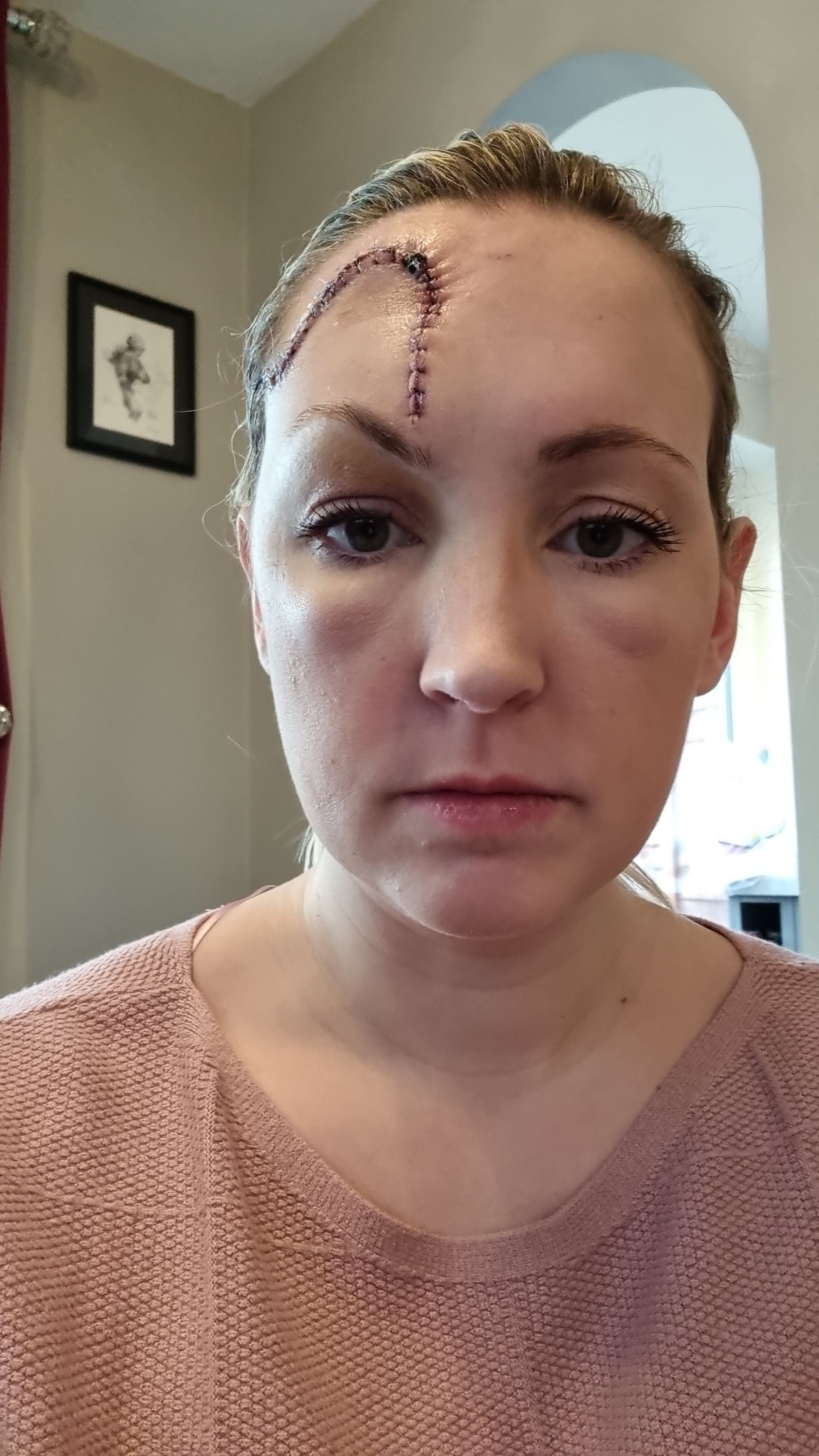 Rachael, from Redditch, Worcestershire, had Cohs surgery to remove cancerous skin cells