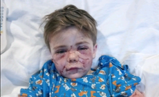 ‘The dog used me as a chew toy, Mummy’: Seven-year-old from Texas left needing surgery after dog attack