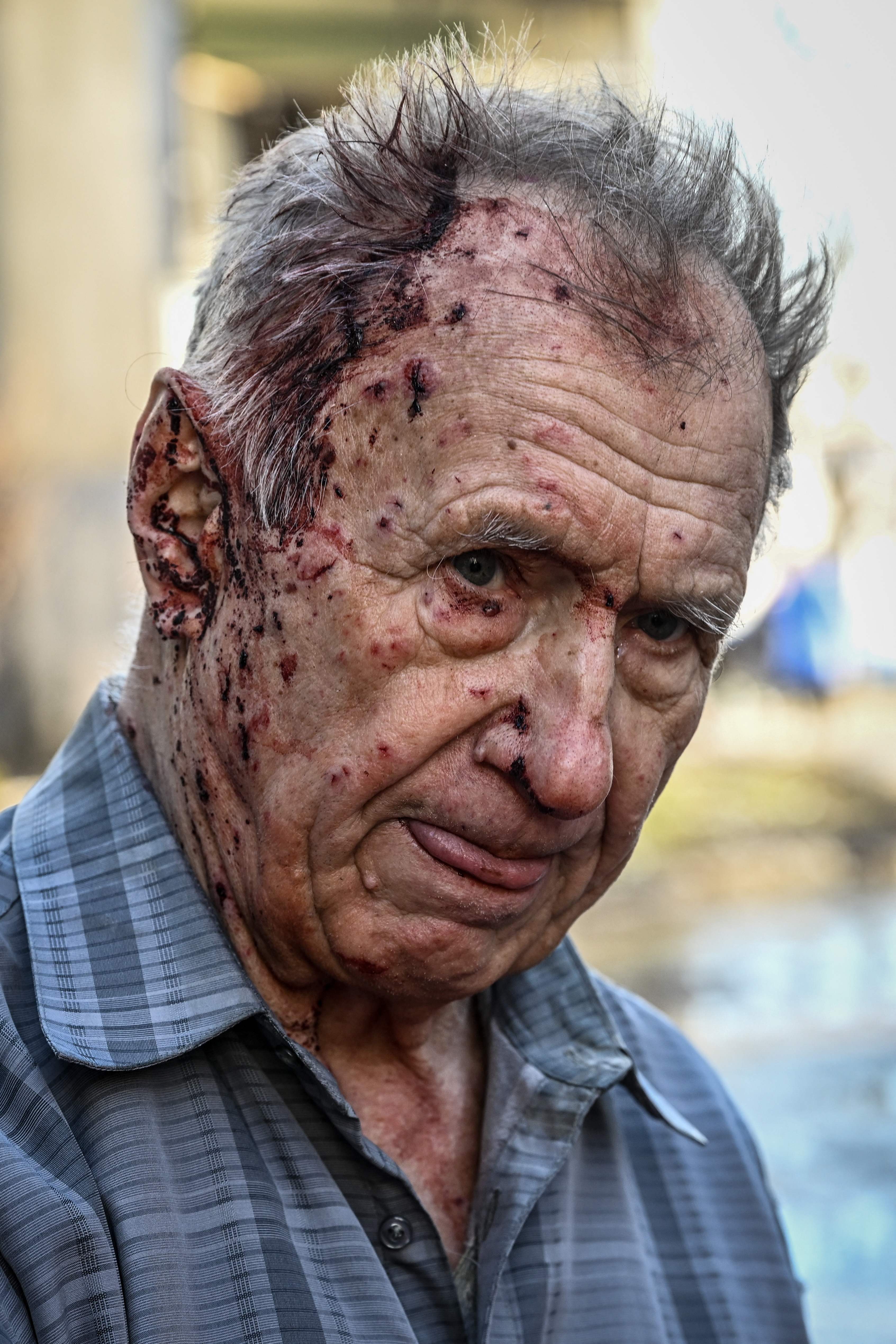 An injured man stands by an emergency vehicle to receive medical assistance after bombings in the eastern Ukraine town of Chuguiv