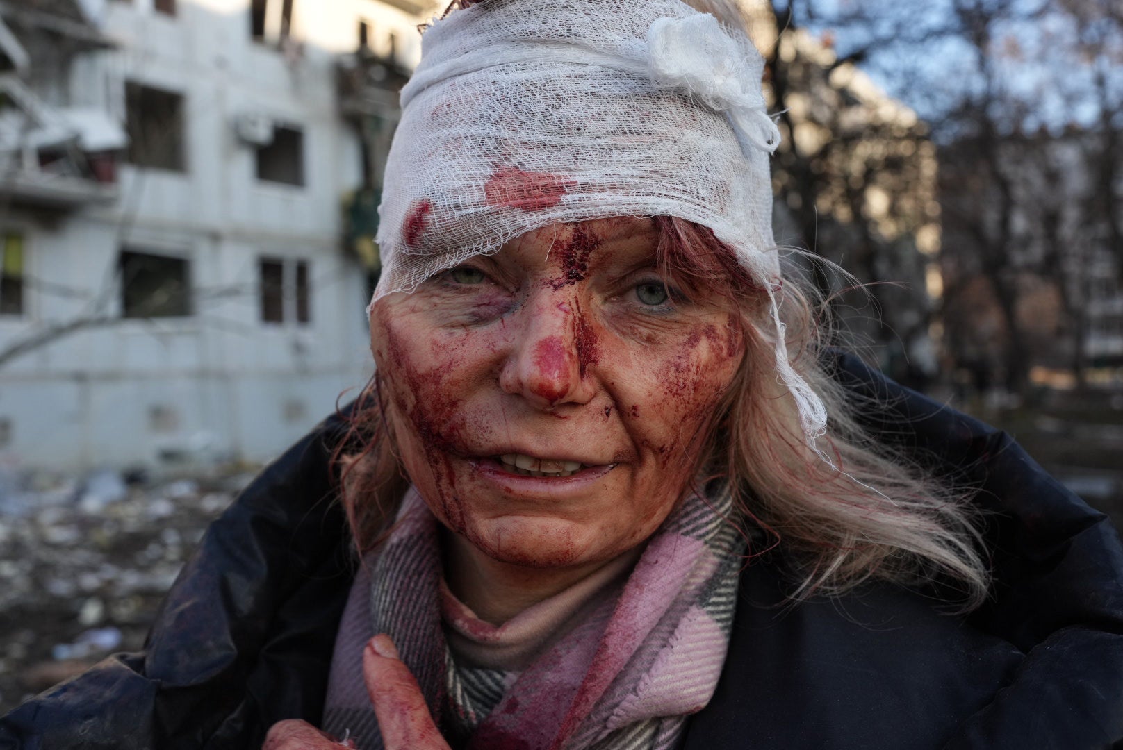 Olena Kurilo, heavily bandaged over her face and head, after a missile struck her home