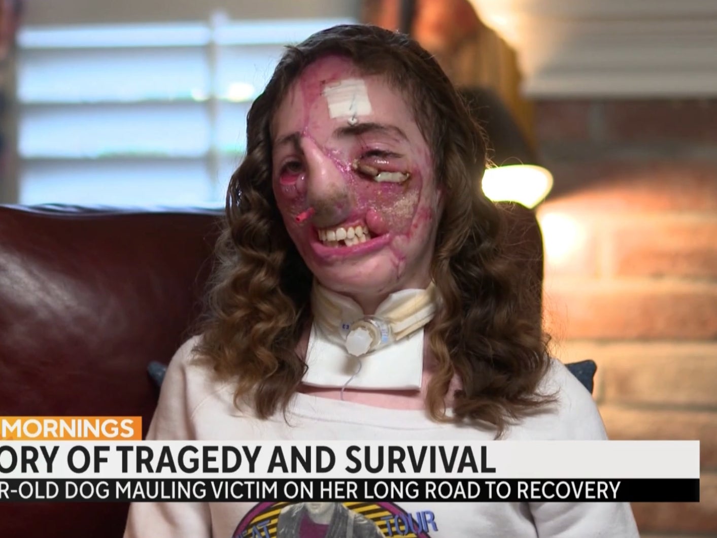 Jacqueline Durand after reconstructive surgery, though still in an early stage of her recovery