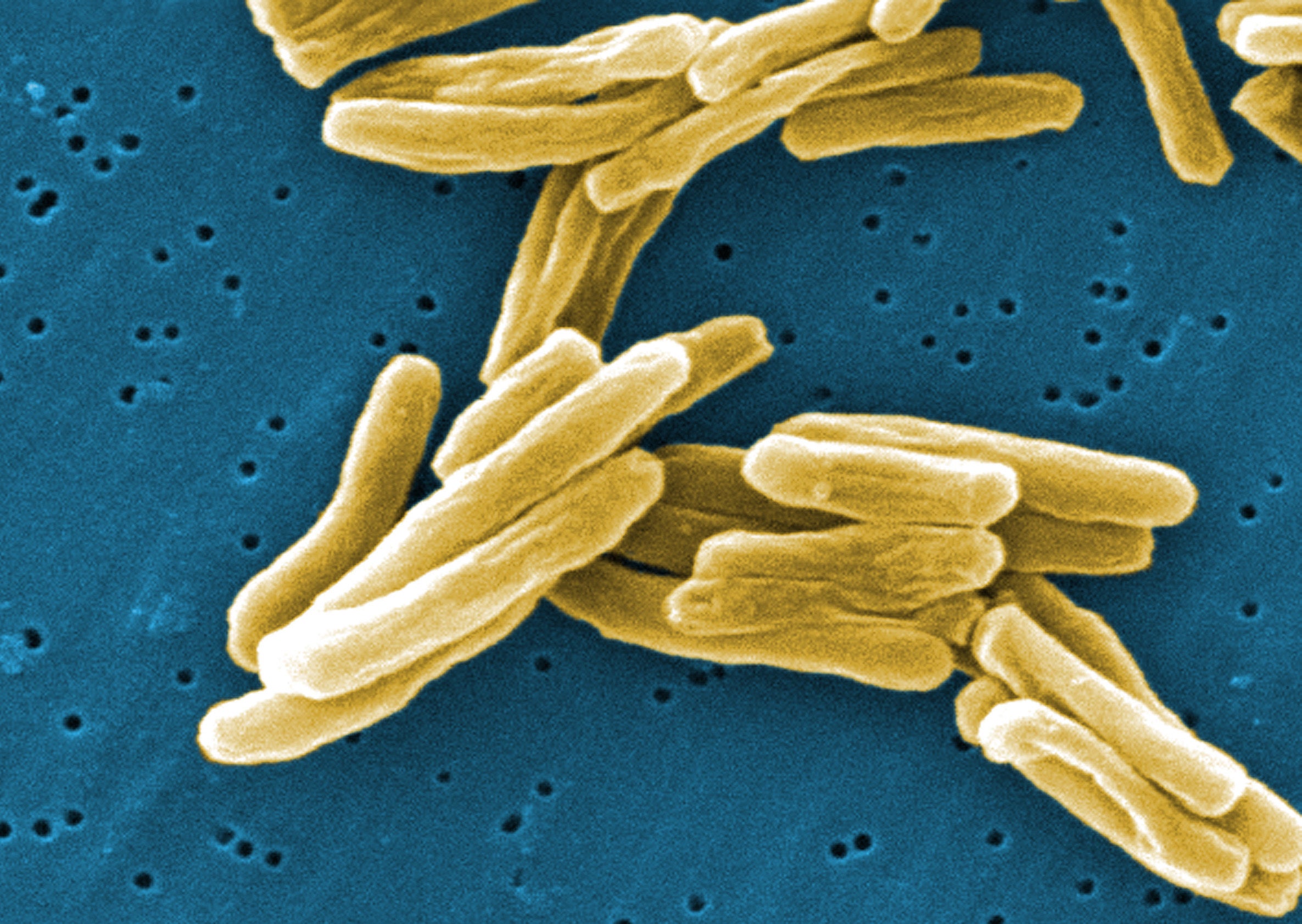 Tuberculosis remains a major killer in low and middle income countries (Janice Carr/Centers for Disease)