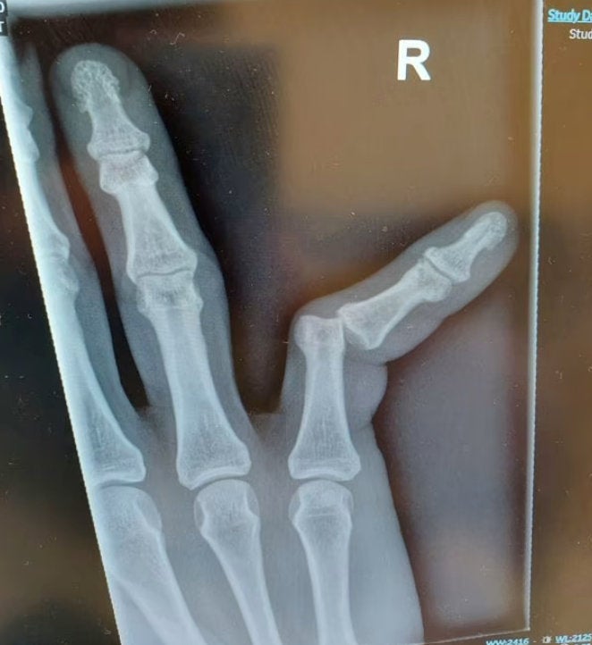 X-ray showing Sergeant Whitt's finger injury