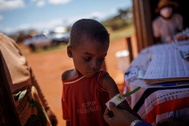 <p>Avoraza, 4, is examined at a children’s malnutrition post run by the World Food Programme</p><p></p><p></p><p></p>