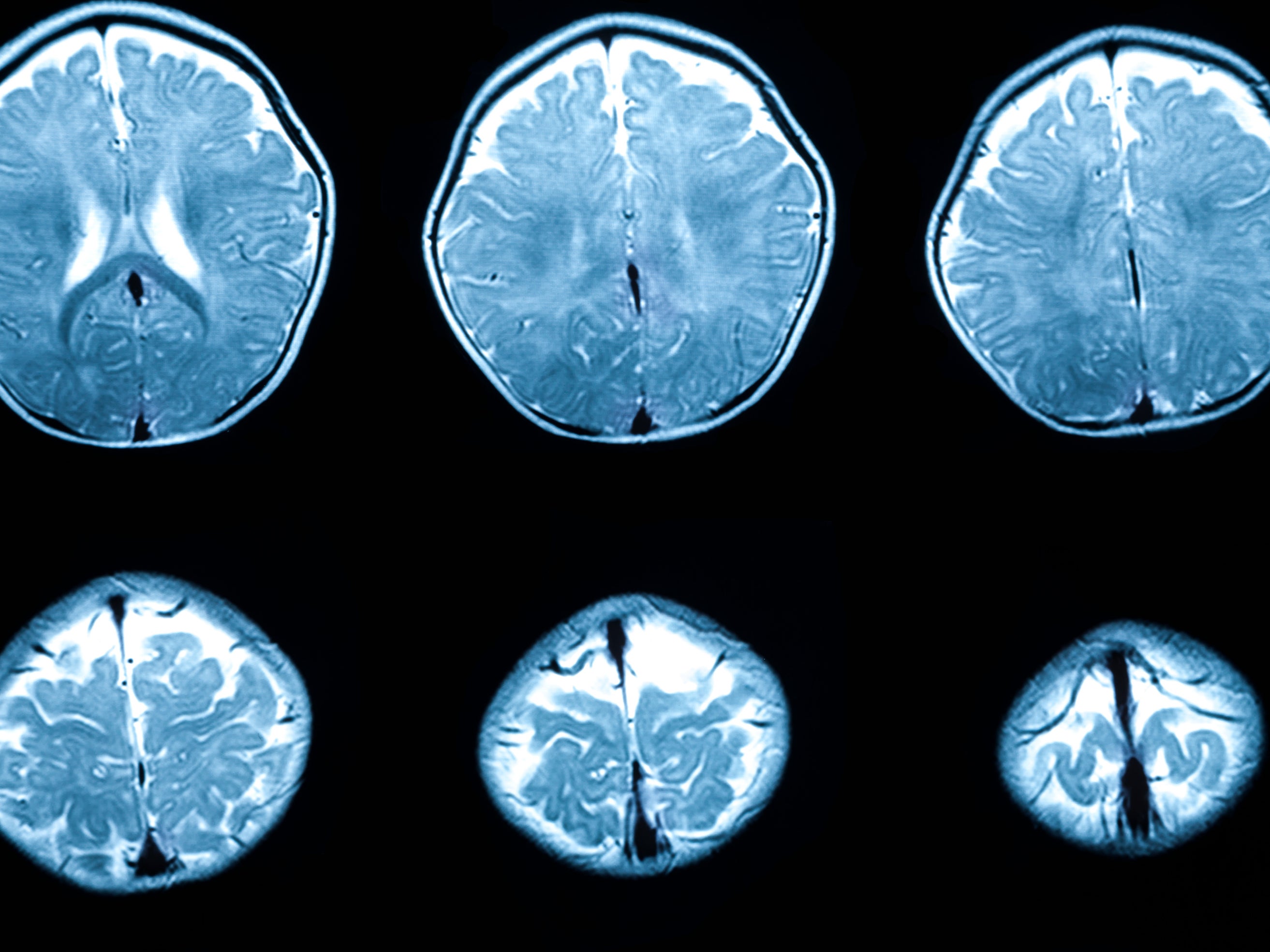 MRI scans, not the one used above, showed babies with mothers facing social disadvantages tended to be born with smaller brains