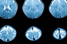 Poverty and crime ‘linked to differences in newborn brains’, study says