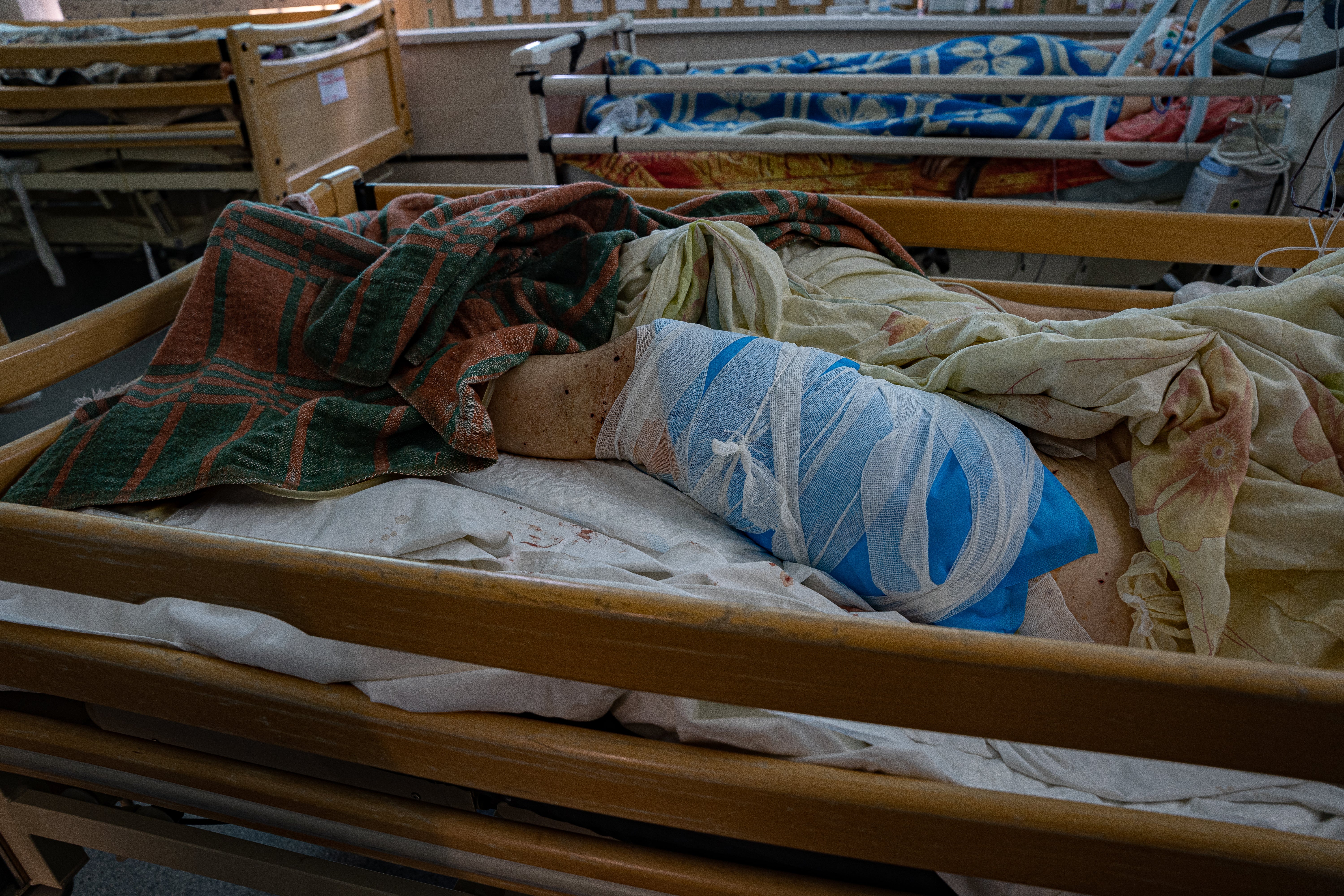 Dima, who picked up an unexploded bomblet, has extensive wounds to his thighs