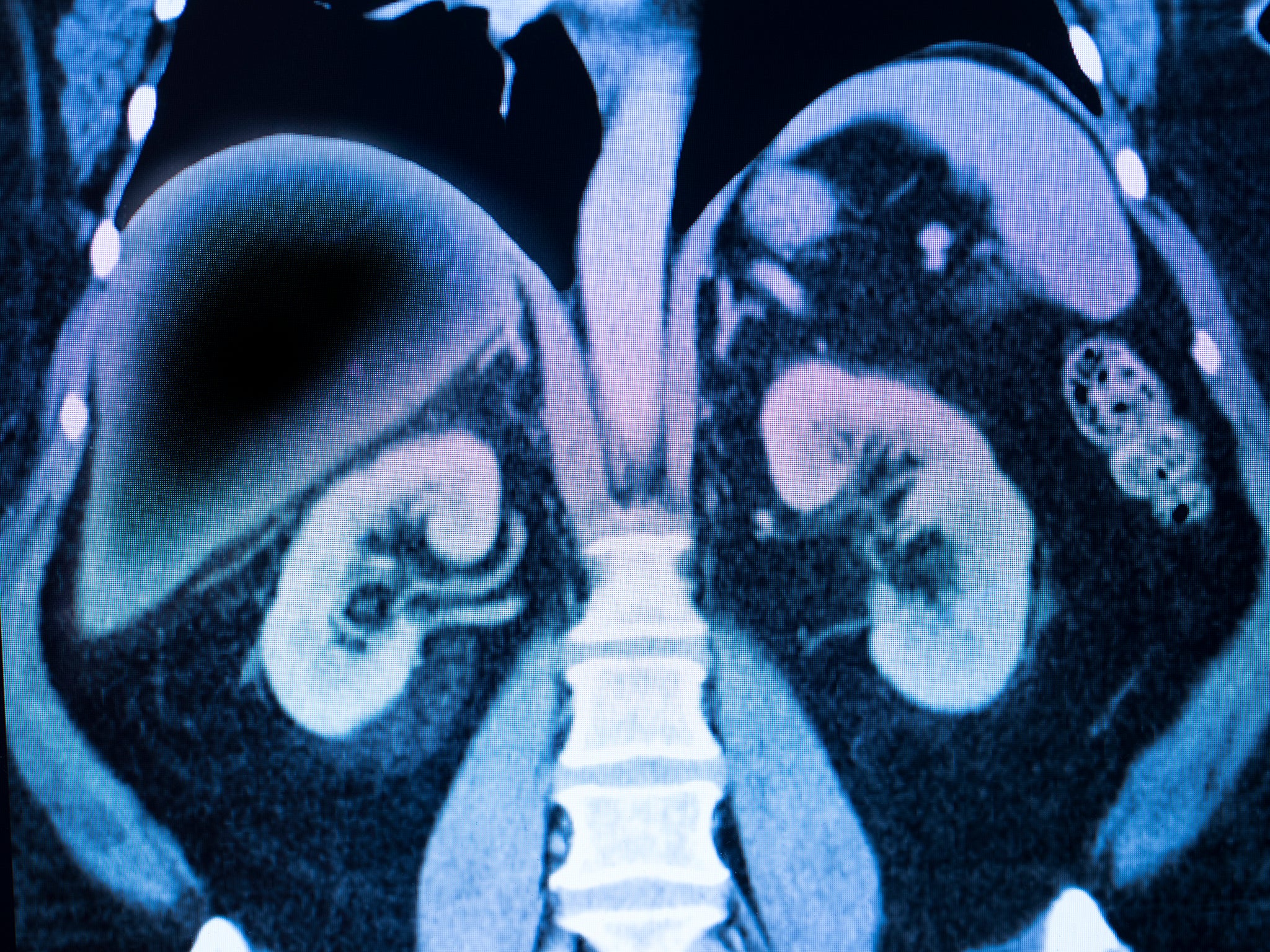 Non-alcoholic fatty liver disease (NAFLD) is triggered when large amounts of fat gather and can result in inflammation, scarring and organ failure