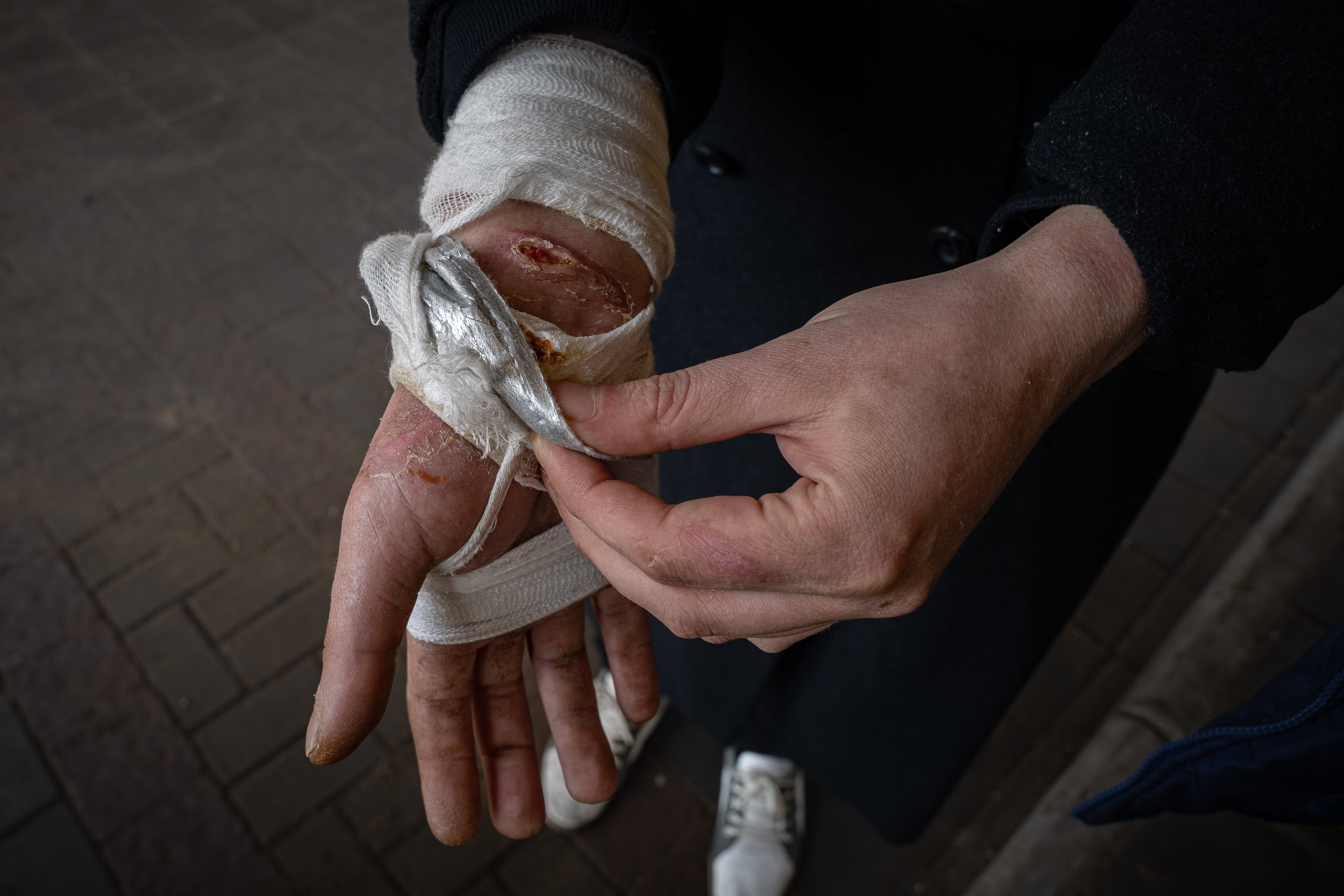 Andrei shows the wounds sustained to his hands and arms from being bound and beaten for several days