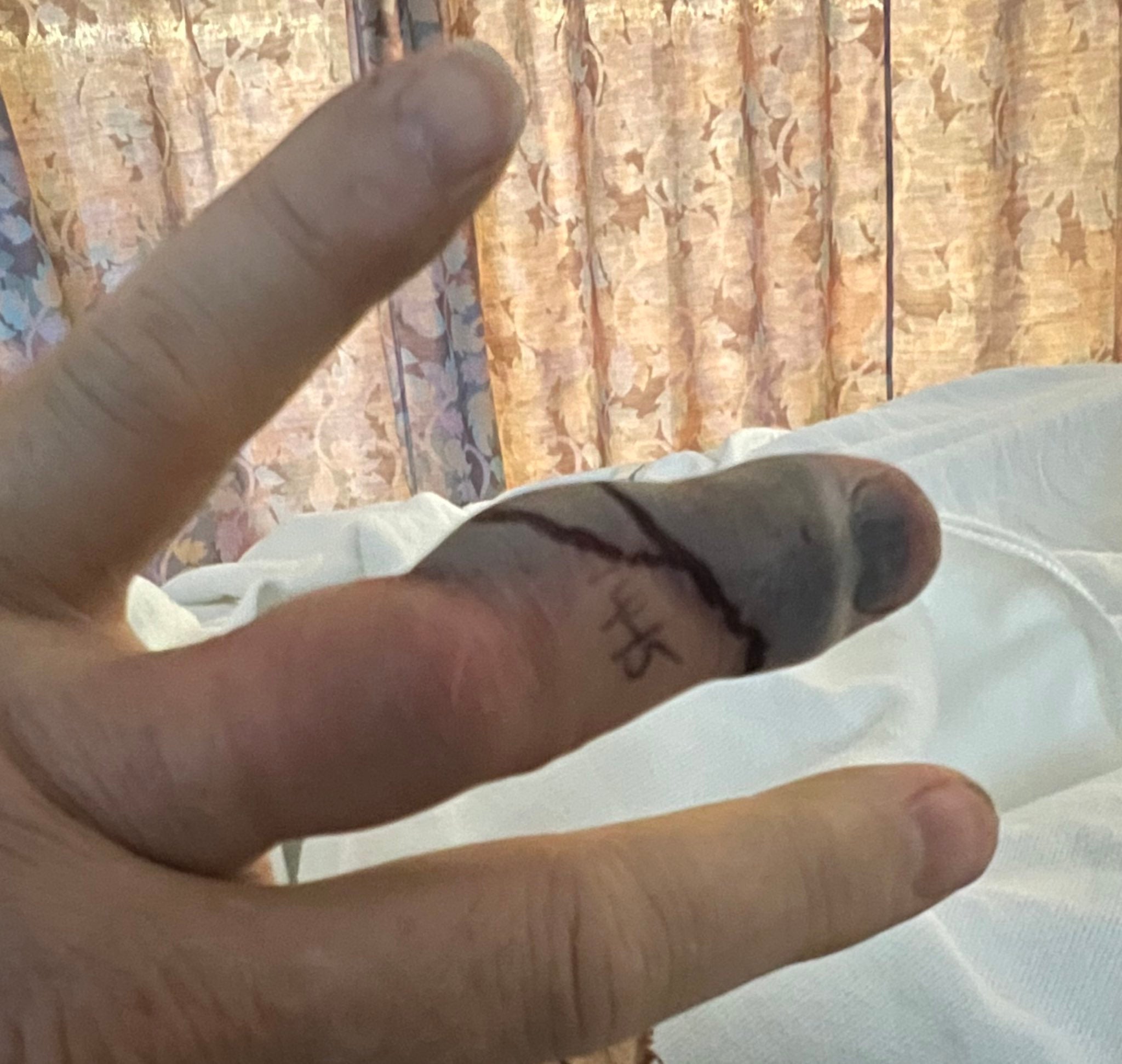 Cary Elwes’ finger after rattlesnake bite